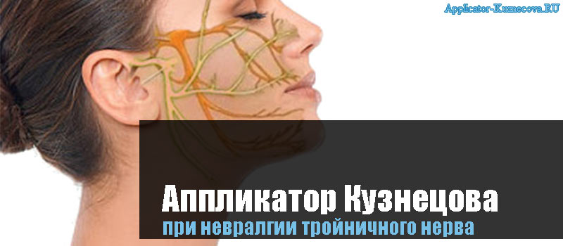 Аппликатор Кузнецова при невралгии тройничного нерва