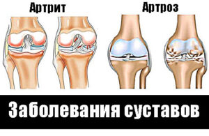 Артрит и артроз Общий корень в названии этих заболеваний указывает на определённую схожесть этих двух недугов. Да, оба заболевания связаны с поражением суставов