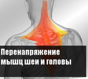 Перенапряжение мышц шеи и головы